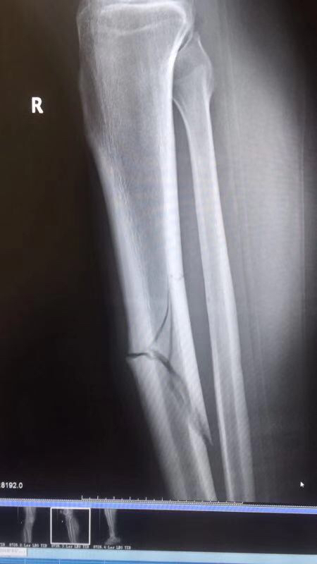 网曝建业新援右腿胫骨骨折首秀破门后遇重伤恐报销